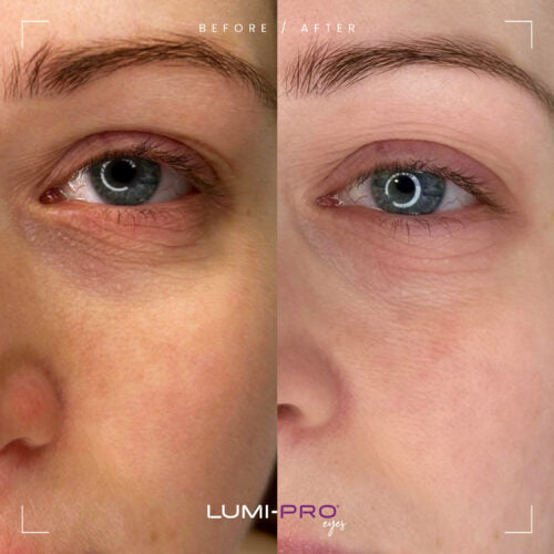 LUMI-PRO Eyes PN Skin Booster | 1x1ml per pack | Polynucleotide (PN) 5 mg/ml