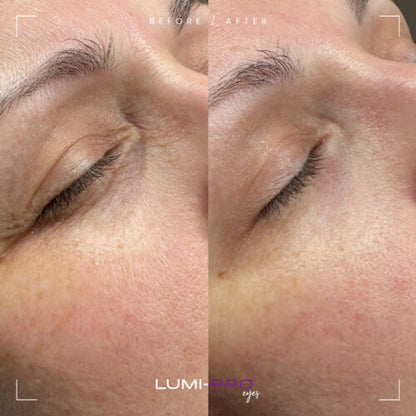 LUMI-PRO Eyes PN Skin Booster | 1x1ml per pack | Polynucleotide (PN) 5 mg/ml